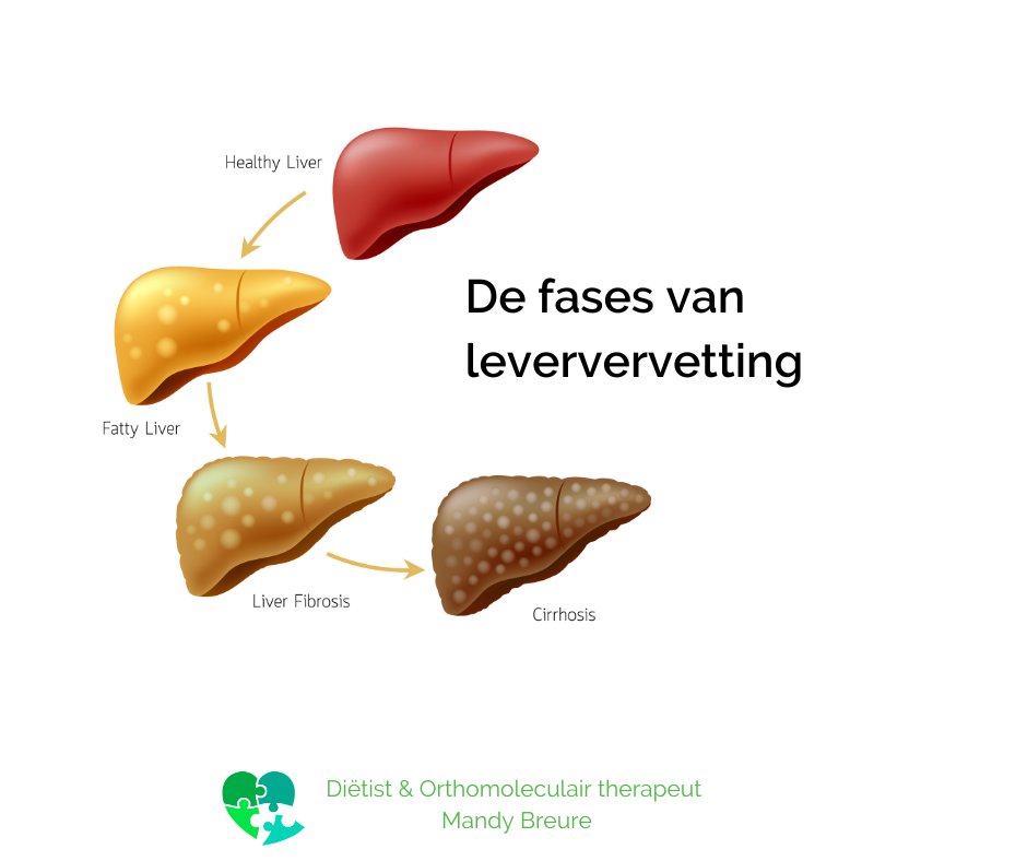 Leververvetting: wat is het en welke impact heeft het?