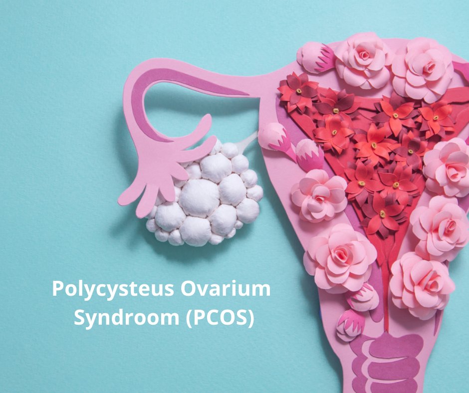 PCOS symptomen